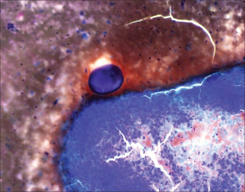 Drug eluting beads on cytology smear (4× diff quik stain)