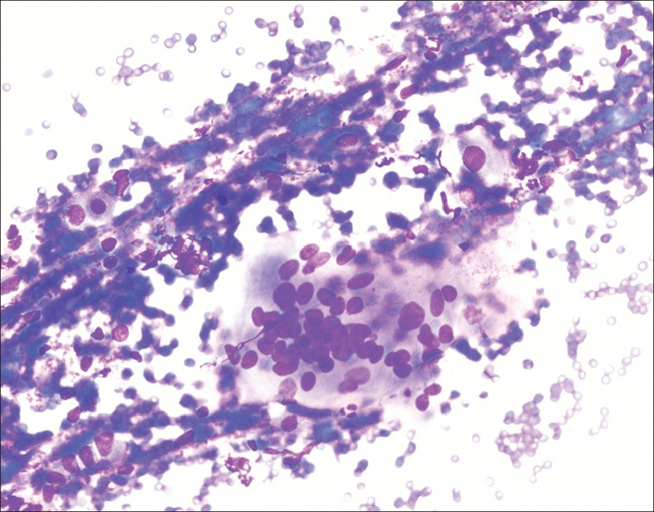 Foreign body type of giant cell (400× diff quik stain)