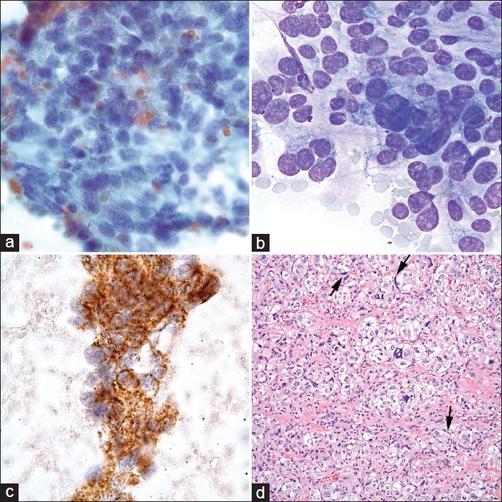 Composite photomicrographs of the tumor showing epithelioid cells arranged in a group with granular chromatins (a, FNA Pap stain, ×40 Obj.); pleomorphic nuclei with nucleoli (b, FNA Diff-Quick stain, ×100 Obj.); and cells with positive staining for synaptophysin (c, FNA, ×100 Obj.). The histological section of the tumor (d, H and E, ×40 Obj.) shows epithelioid or chief cells which are arranged in a pseudoalveolar pattern (Zellballen) nested in a vascular stroma which were positive for synaptophysin but negative for cytokeratin. Hyperchromatic spindle shaped sustentacular cells are at the periphery of the chief cell nests (arrows). They were only positive for S-100