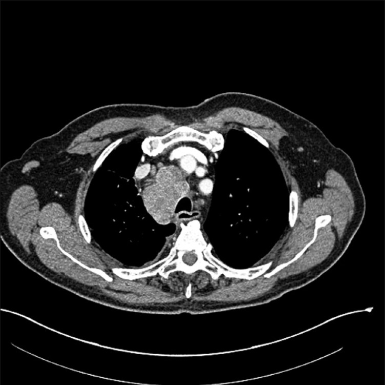 CT image of chest showing right hilar mass and enlarged mediastinal lymph nodes