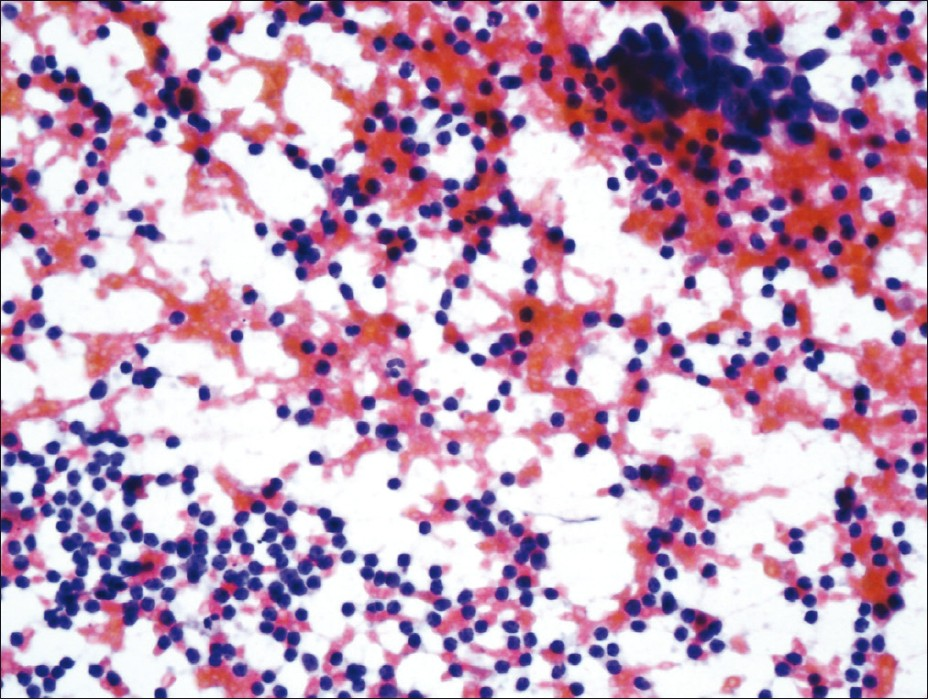 FNA smear (PAP stain) showing malignant cells in clusters and numerous lymphocytes in the background