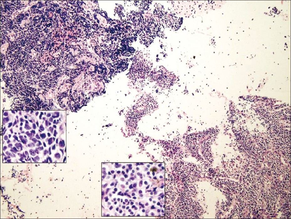 Cell block tissue section showing small cell carcinoma (upper left corner) and lymphocytes (lower right corner)