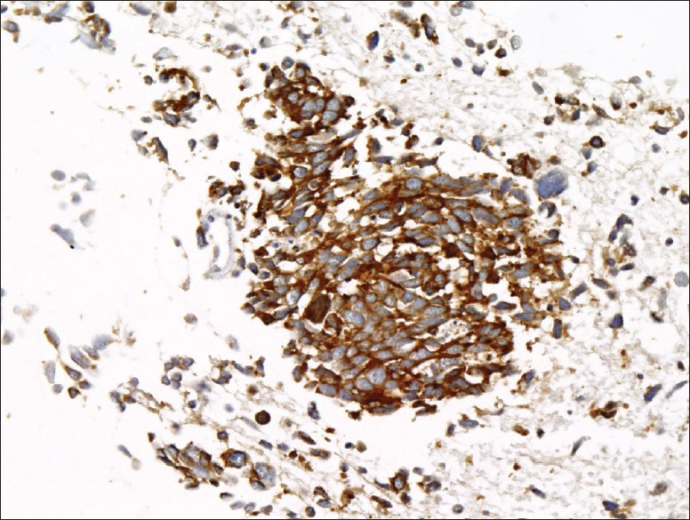 Cell block tissue section showing small cell carcinoma positive for synaptophysin