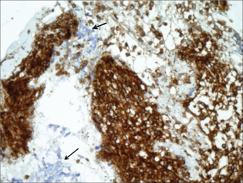 Cell block tissue section showing small cell carcinoma negative for CD45 (arrows) and numerous lymphocytes positive for CD45