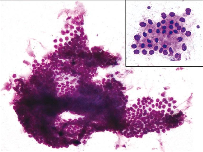 Photomicrograph showing monolayered sheets of benign ductal cells (MGG, 10×) and inset showing loosely cohesive acini of benign ductal cells with moderate cytoplasm (MGG, 40×)