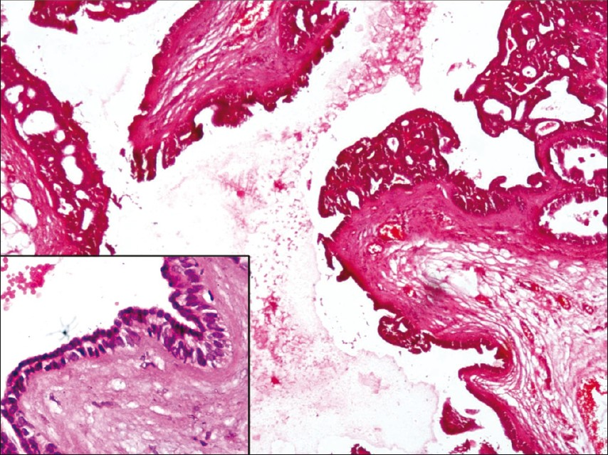 Photomicrograph showing cystic spaces lined by a double layer of cuboidal epithelium thrown into small papillae at places (H and E, 10×) and inset showing cystic spaces lined by a double layer of cuboidal epithelium (H and E, 40×)