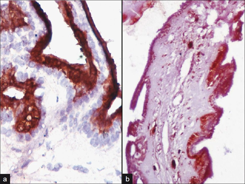 (a) Photomicrograph showing cytoplasmic CK7 positivity in luminal cells (CK7, DAB, 40×), (b) Photomicrograph showing cytoplasmic S100 positivity in abluminal cells (S100, DAB, 10×)