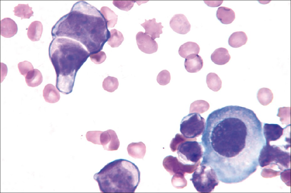 A pair of neoplastic cells (upper left) shows scant cytoplasm, irregular nuclear contours, visible small nucleoli, and a possible inter-cellular ‘window’. The cytoplasmic eosinophilia of the neoplastic cells contrast with the cytoplasmic basophilia of the larger reactive mesothelial cell (lower right) (Wright stain, ×1000)