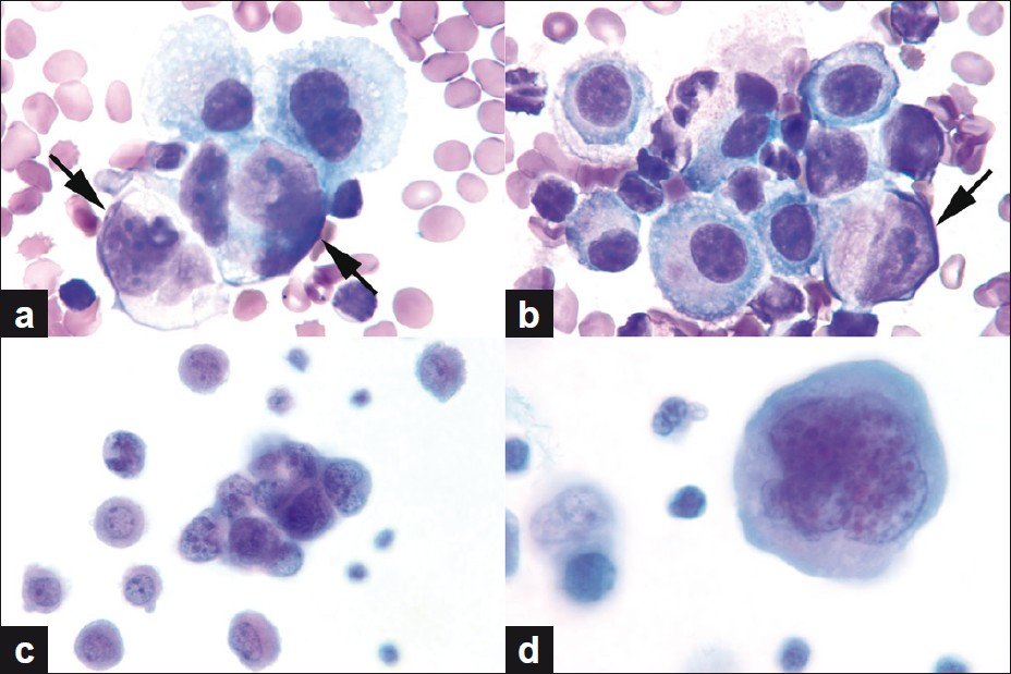 (a, b) Neoplastic cells (arrows) intermixed with reactive mesothelial cells. Note the eccentric location of the nuclei of neoplastic cells. (c) Tight 3D cluster of small undifferentiated tumor cells. (d) Multilobated / multinucleated, large, pleomorphic tumor cell with dense cytoplasm (a, b. Wright stain, c, d. Papanicolaou stain, all images original magnification, ×1000)