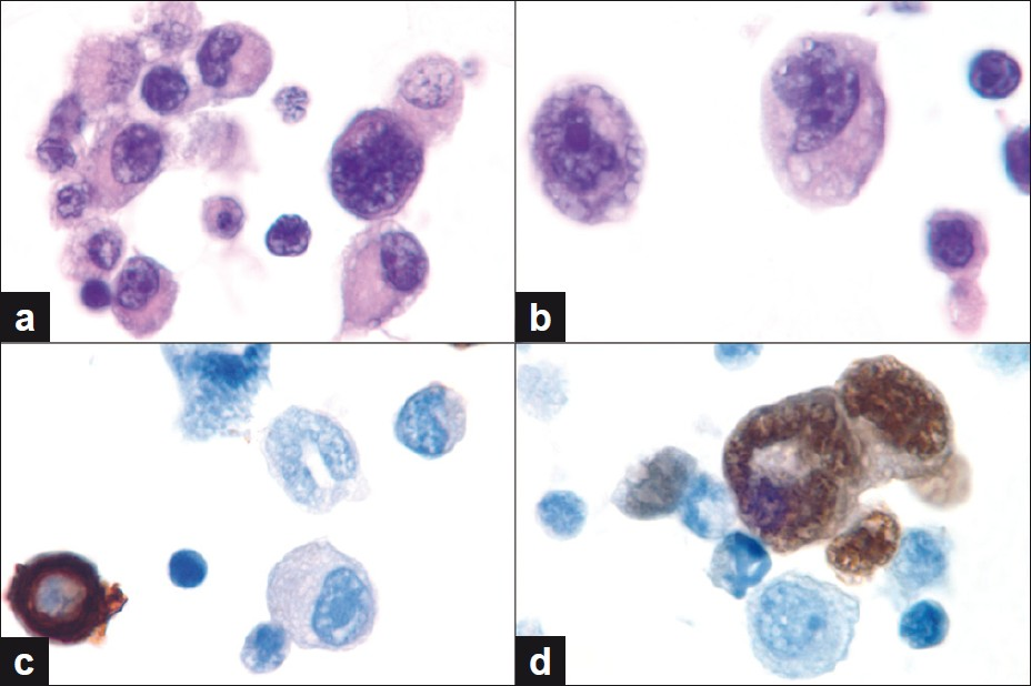 (a, b) Cell block findings showing neoplastic cells admixed with reactive mesothelial cells and lymphocytes. Note the hyperchromatic nuclei and prominent nucleoli of the neoplastic cells. (c, d) Immunoperoxidase studies for cytokeratin AE1 / AE3 and myogenin show lack of tumor cell staining for CK and nuclear positivity for myogenin. Mesothelial cells show the opposite staining pattern. (a,b: Hematoxylin and Eosin, c,d: Immunoperoxidase stains, all images original magnification, ×1000)