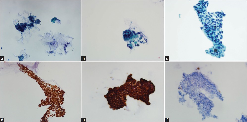 Bronchial brushings in Thin Prep (a) Scanning view showing columnar cell clusters in mucoid background (Papanicolau stain ×40) (b) Rare cluster of bronchial epithelial cells with terminal bars and cilia (Papanicolau stain ×400) (c) Many clusters composed of disorganized columnar cells with abundant vacuolated cytoplasm and irregular nuclear contours (Papanicolau stain ×400) (d) CDX2 nuclear positive stain (×400) (e) CK20 positive stain (×400) (f) CK7 negative stain (×200)