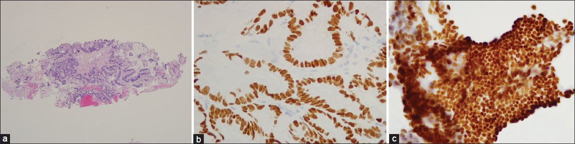 Concurrent bronchial biopsy specimen showing well differentiated mucin secreting adenocarcinoma with vacuolated cytoplasm and irregular nuclear outlines (a) H and E, ×100 (b) CDX2 and (c) CK20 are positive (×400)