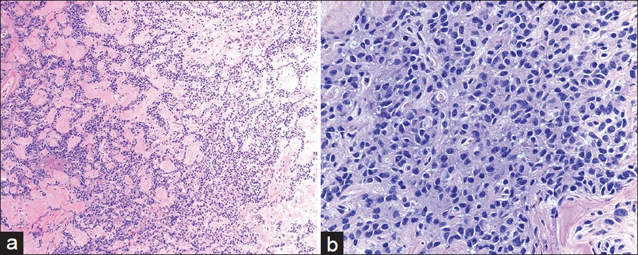 Histomorphologic features of pancreatic neuroendocrine neoplasm in follow-up. The resected tumor was well-circumscribed and had relatively uniform epithelial cells arranged in trabecular and gyriform growth patterns with eosinophilic stroma (a) H and E, ×100. The tumor cells have esoinophilic cytoplasma and eccentrically located round to oval nuclei with speckled chromatin (b) H and E, ×400