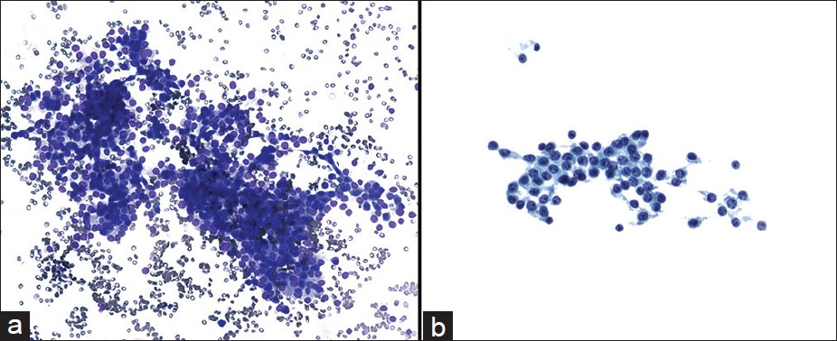 Cytmorphological features of pancreatic neuroendocrine neoplasms diagnosed by endoscopic ultrasound-guided fine needle aspiration biopsy. The aspirate showed loosely cohesive clusters of realtively uniform epithelial cells in a bloody background (a) Diff-Quik, ×200. The tumor cells had eccentrically located round to oval nuclei with speckled chromatin and small nucleoli (b) Papanicolaou, ×400