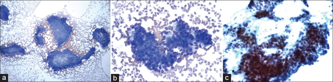 Cytmorphological features of the case with the cytological differential diagnosis including pancreatic neuroendocrine neoplasm and well-differentiated adenocarcinoma. The aspirate had modest cellularity ((a) Diff-Quik, ×100) and showed cohesive clusters of epithelial cells with in increased nuclear to cytoplasmic ratios and mild aniuncleosis ((b) Diff-Quik, ×400). The tumor cells had relapping hyperchromatic nuclei with small nucleoli ((c) Papanicolaou, ×400)