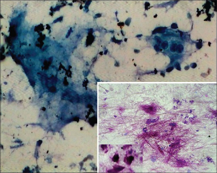 Amorphous granular material and foreign body giant cell (Papanicolaou ×20) (Inset showing elongated crystals MGG x20)