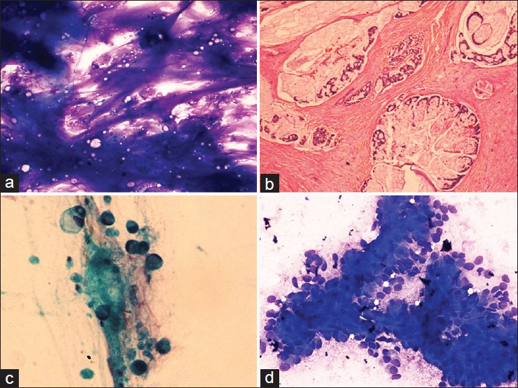 (a) Tumor cells floating in abundant extracellular mucin, May Grunwald Giemsa (MGG) ×100, (b) mucinous carcinoma showing clusters of tumor cells lying in pools of mucin, H and E, ×100, (c) singly lying tumor cells with abundant intracellular mucin pushing the nucleus to the periphery signifying signet ring appearance, papanicolaou ×400, (d) tumor cells showing moderate nuclear pleomorphism and arranged in cohesive fragments, MGG ×200