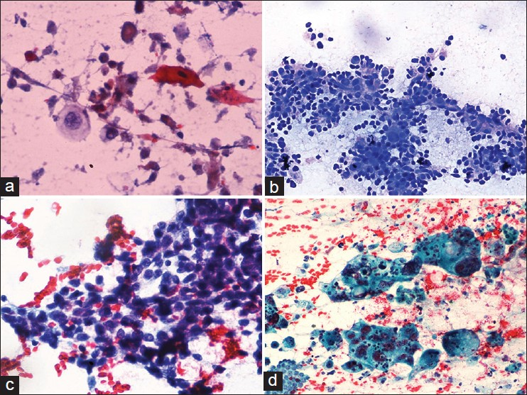 (a) Squamous differentiation is typified by atypical keratinized cells with dense cytoplasm and pyknotic nuclei in a necrotic background, Papanicolaou (Pap ×400), (b) Tumor cells showing dramatic anisonucleosis and nuclear molding with rosettes representing neuroendocrine differentiation, May Grunwald Giemsa ×200, (c) Tumor cells show hyperchromatic nuclei with salt and pepper nuclear chromatin and molding in a case of small cell carcinoma, Pap ×400, (d) Large markedly pleomorphic tumor giant cells exhibit neutrophilic phagocytosis, Pap ×400