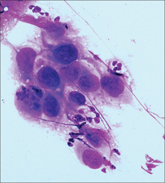 Medullary renal cell carcinoma. A cluster of cohesive malignant cells displaying high nuclear to cytoplasm ratio and eccentrically placed pleomorphic nuclei with coarse chromatin. Note the mitotic figure and the neutrophils in the background (Diff-Quik stain, ×400)