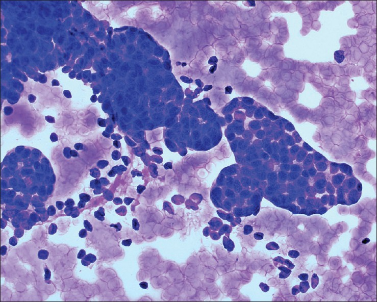 Metanephric adenoma. The aspirate was very cellular with uniform, hyperchromatic tumor cells with a scant amount of cytoplasm arranged in tight clusters and tubules. The background is clean with no necrosis, mitotic figures, or apoptotic bodies. Tumor cells were positive for WT-1 and CD57 and negative for CK7 (Diff-Quik stain, ×400)