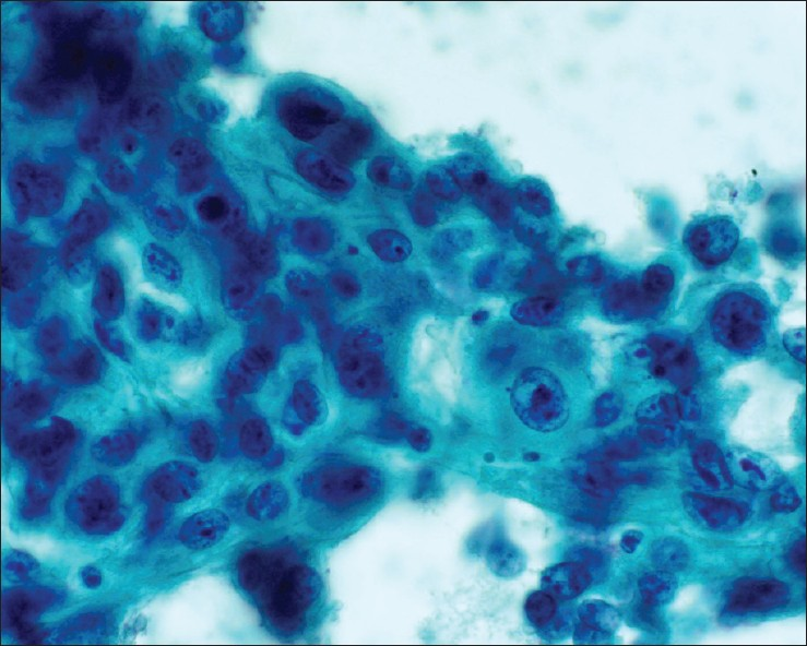 Metastatic lung squamous cell carcinoma. Malignant cells with distinct cell borders, moderate amount of dense cytoplasm and significant nuclear atypia. Tumor cells were positive for CK5 and P63. Patient had a known history of lung squamous cell carcinoma (Papanicolaou stain, ×600)