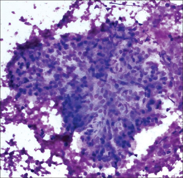 Normal renal glomerulus. Cellular group with distinctly lobulated contours. Although the cells are bland, the cellularity and three dimensional architecture may create confusion with a neoplasm (Diff-Quik stain, ×200)