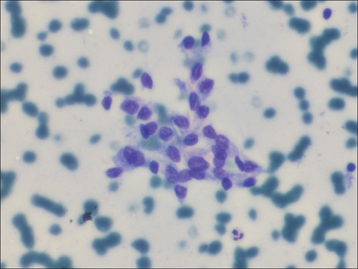 Case 2. Follicular cells with enlarged round to ovoid overlapping nuclei and occasional nuclear grooves (Diff-Quik, ×400)