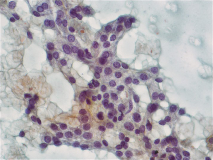 Case 2. Follicular cells with focally enlarged round to ovoid nuclei and small nucleoli (Papanicolaou, ×400)