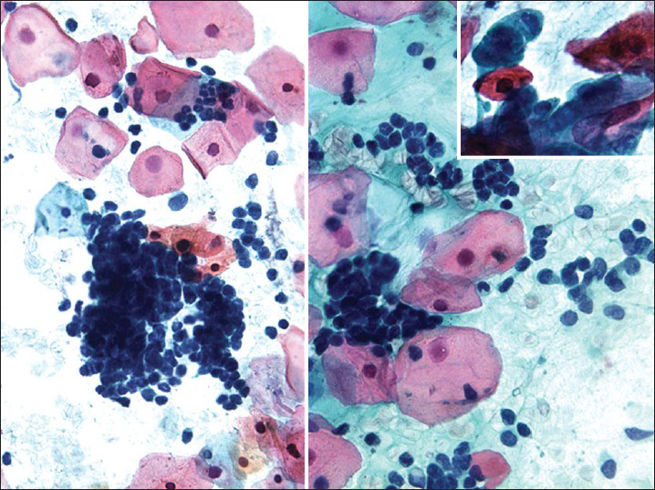 High-grade squamous intraepithelial lesion of small cell type seen in a conventional Pap test. The hyperchromatic dysplastic cells are seen singly and in clusters (syncytial-like) (Pap stain, ×400). The insert shows the presence of a few accompanying dysplastic keratinizing squamous cells