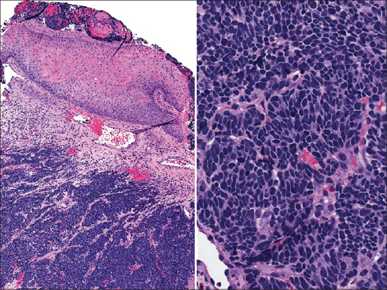 Cervical biopsy with small cell carcinoma (corresponding to Pap test of case shown in Figure 2. H and E stain, ×100 [left] and ×400 [right])