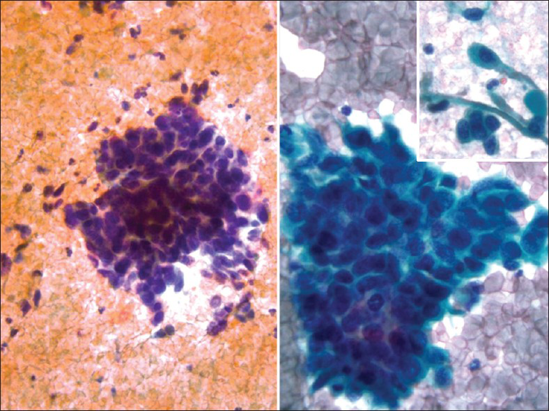 Squamous cell carcinoma with small cell morphology in a conventional Pap test. The malignant cells are single and in clusters showing scant cytoplasm and small cell morphology with nuclear molding. However, few clusters and single cells showing characteristic squamous cell morphology with dense cytoplasm (right). The follow-up biopsy confirms squamous cell carcinoma (Pap stain, ×400)