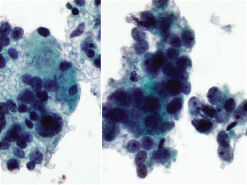 Large neuroendocrine carcinoma in a ThinPrep Pap test from a 24-year-old female. The malignant cells are loosely cohesive. The nuclei are only mildly pleomorphic with one or more prominent nucleoli (Pap stain, ThinPrep, ×400)