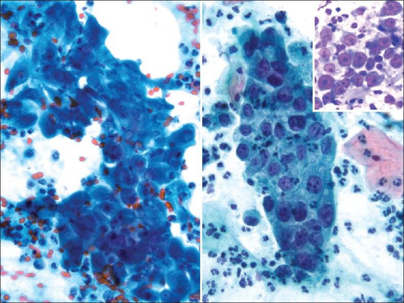 Glassy cell carcinoma. The tumor cells are arranged in sheets with abundant granular (ground-glass-like) cytoplasm, large pleomorphic nuclei, coarse irregular chromatin and prominent nucleoli. An inflammatory cell infiltrate is present (Pap stain, ×400). Insert: Corresponding cervical biopsy showing prominent/large nucleoli (H and E stain, ×400)