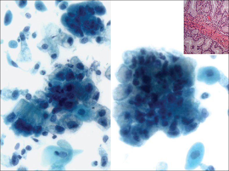 Adenoma malignum in a liquid based preparation (SurePath). The specimen shows large numbers of atypical glandular clusters associated with some single endocervical-like cells with yellow/golden vacuolated cytoplasm. The cells have abnormal nuclei (enlargement, pleomorphism, crowding, visible nucleoli and loss of polarity) (Pap stain, ×400). Insert: Corresponding cervical biopsy (H and E stain, ×400). Images courtesy of Dr. David C. Wilbur, Massachusetts General Hospital, Boston, MA, USA