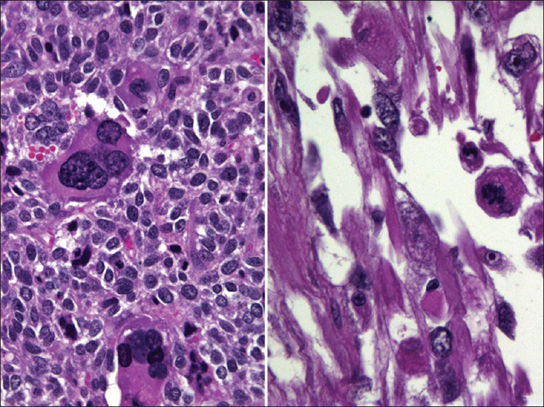 Histopathology of malignant mixed Müllerian tumor corresponding to the case shown in Figure 8. The tumor shows combined adenocarcinoma and rhabdoid components (heterologous element) (H and E stain, ×400)