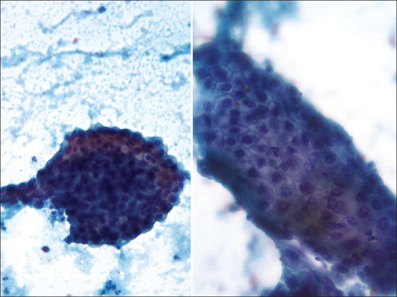 Clear cell carcinoma in a conventional Pap test. The smear shows tumor cells arranged in sheets and papillae with abnormal pleomorphic nuclei and a tigroid-background (left) (Pap stain, ×200 [left], and ×400 [right])