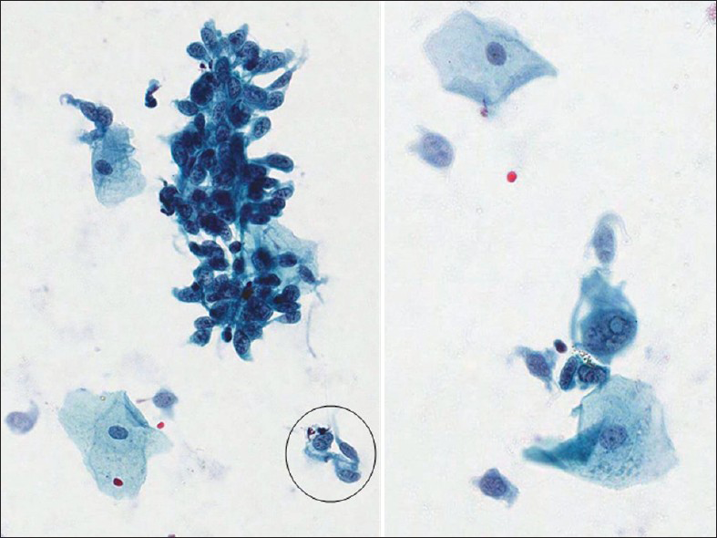 Malignant spindle cell melanoma from a 73-year-old patient in a conventional cervicovaginal smear. There are numerous single and clusters of spindle cells, among mature squamous cells, showing pleomorphic abnormal nuclei with central grooving (circle) and intranuclear psudoinclusion (right) (Pap stain, ×400). The follow-up in this case showed primary malignant melanoma of the vagina