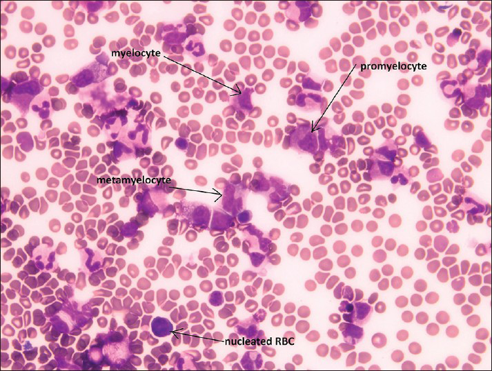 Cerebrospinal fluid containing bone marrow elements including promyelocyte, myelocyte, metamyelocyte and nucleated red blood cells