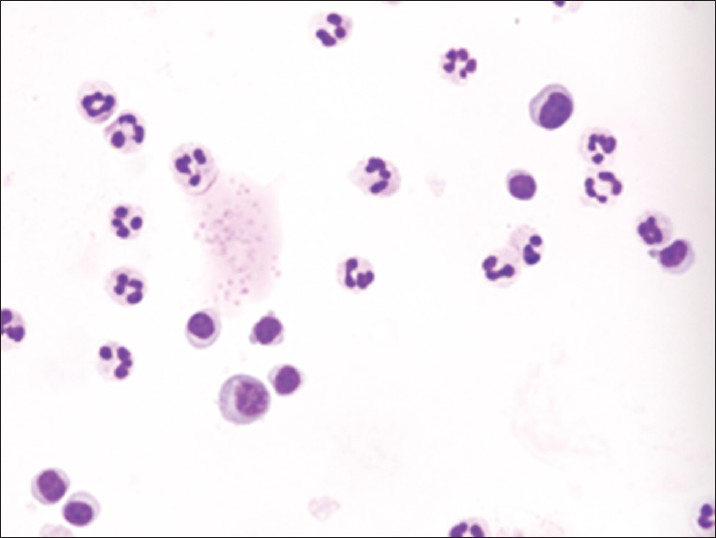 Neutrophilia together with small numbers of normal and activated lymphocytes