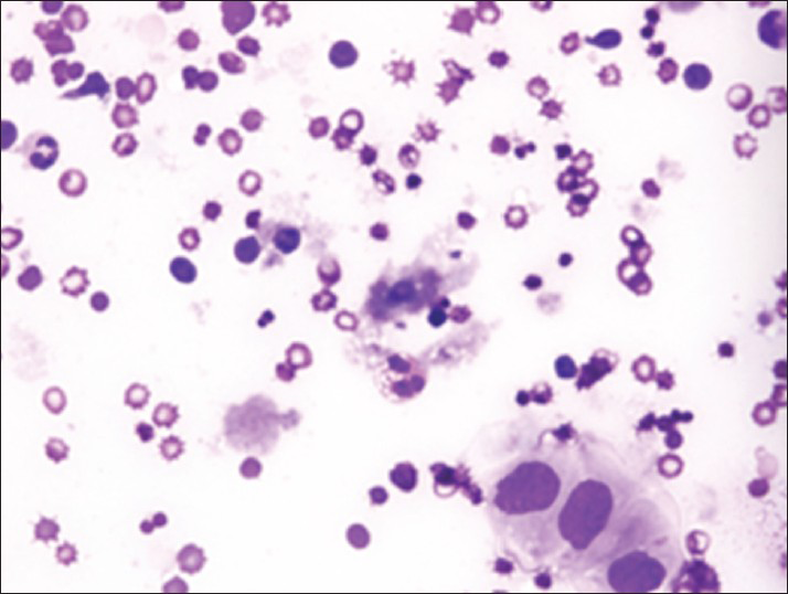 Malignant cells of metastatic squamous cell carcinoma surrounded by polymorphous inflammation