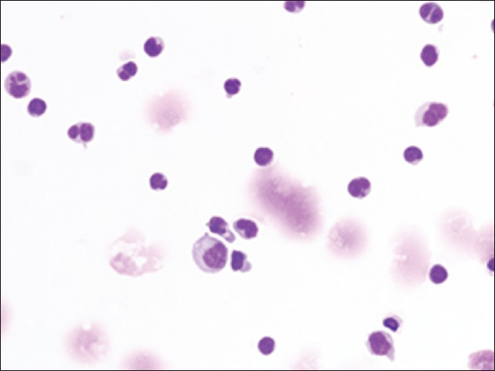 Viral meningitis showing normal and activated lymphocytes with and scattered macrophages