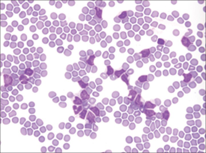 Acute lymphoblastic leukemia containing numerous lymphoblasts