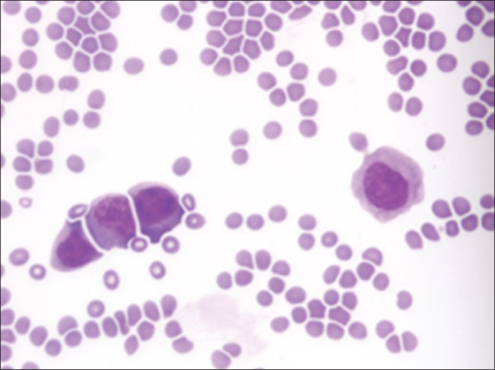 Abnormal blasts in B-cell non-Hodgkin's lymphoma