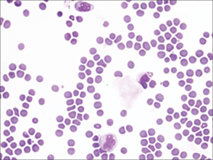 Contaminant peripheral blood containing abnormal blasts