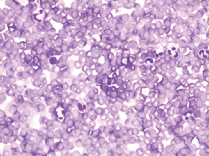 Traumatic tap showing numerous red blood cells with scattered neutrophils and lymphocytes consistent with peripheral blood