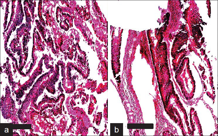 Aperio Images of adenocarcinoma colon stained with H&E. a) MFPE Cellient block prepared from tissue and b) MFPE block prepared from scrapings collected in ThinPrep vial. Scale bar represents 300um.