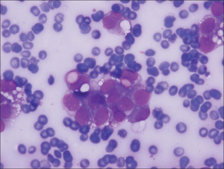 The clear vacuoles were often single but numerous clear vacuoles were also observed both in neoplastic groups and single, discohesive, plasmocytoid neoplastic cells (Diff-Quik, smears)