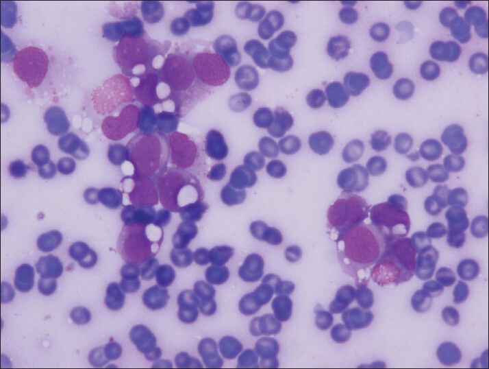 Small groups of cells with clear cell vacuoles in variable sized (Diff-Quik, smear)