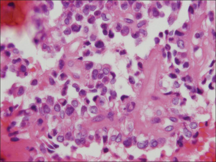 The vacuoles can be seen foamy to clear on cell block preparation (H and E, cell block)