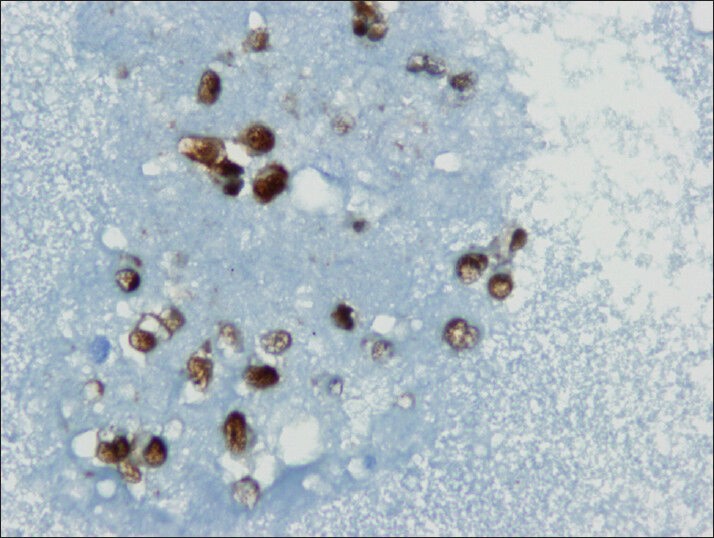 Neoplastic cells shows nuclear immuno reactivity with beta-catenin (cell block)